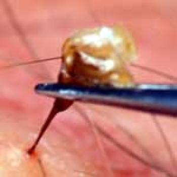 Upclose picture of a stinger being removed with tweezers from a persons arm