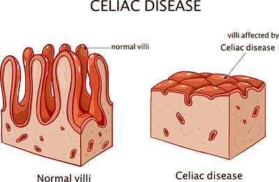 Celiac disease diagram of normal villi and villi affected by coeliac disease