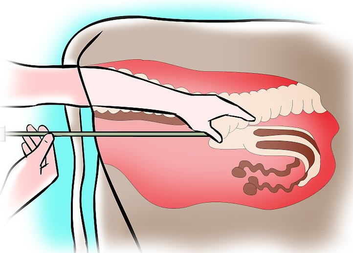 artificial insemination of a cow on an illustration artificial insemination of a cow on an illustration