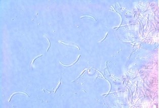 Cherry Leaf Spot | microscopic view Microscopic picture of the long, thin spores of the cherry leaf spot fungus Blumeriella jaapii